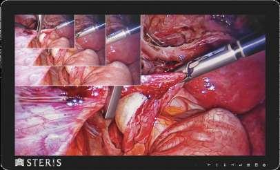 STERIS Vividimage 4K Surgical Field Display Application 4K Surgical Field Viewing / Tableside Guidance Pristine Image Quality 4K Visualization VectorSharp image