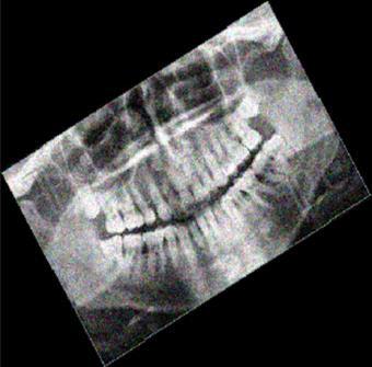 2 (c) Registered image. V. CONCLUSION Appropriate and efficient hybrid technique of registering dental X-ray is presented here.