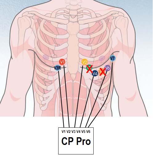 Pediatric Lead Set differences: CPWS vs. CP200 CPWS expects the user to apply the electrodes in the appropriate locations, and then attach the leads in sequence from right to left.