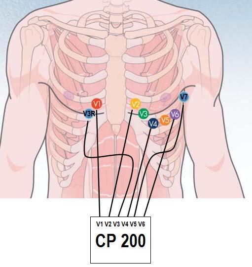 Pediatric Lead Placement Anatomical site (Right to Left) V3R V1 V2 V4 V6 V7 Lead wire CPWS V1 V2 V3 V4 V5 V6 Lead wire CP200 V3 V1 V2 V4 V6 V5 Added an auto-restart option for the Resting ECG