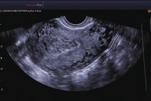 enhance ultrasound imaging.