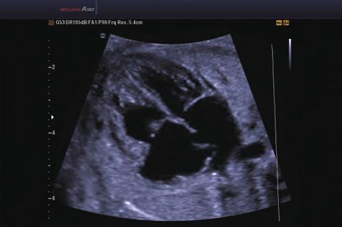 conditions Early Fetus 3D