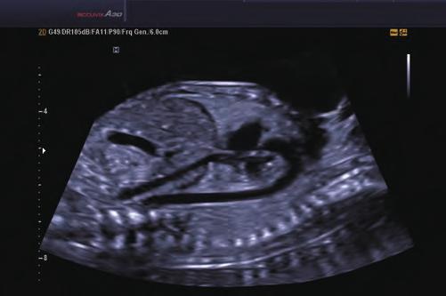 Zoom image of fetal heart