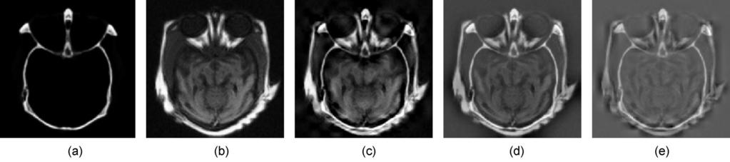 8 Image fusion with medical images (256 256 pixels): (a) image A (CT), (b) image B (MRI), (c) image fused by iterative adwti, (d) image fused by Laplacian pyramid, and (e) image fused  9 Image